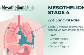 Malignant Pleural Mesothelioma: Survival Rate Overview