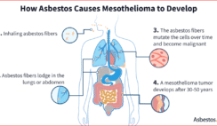 Mesothelioma: Understanding the Disease, Its Causes, and Your Options