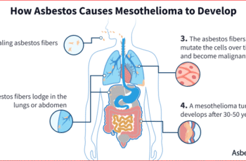 Mesothelioma: Understanding the Disease, Its Causes, and Your Options
